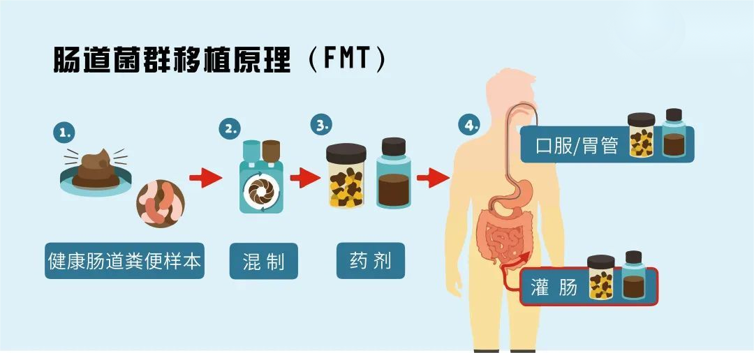 肠道菌群移植常用方法？